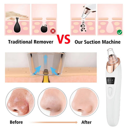 Deep Pore Cleaner – Electric Blackhead Removal Device
